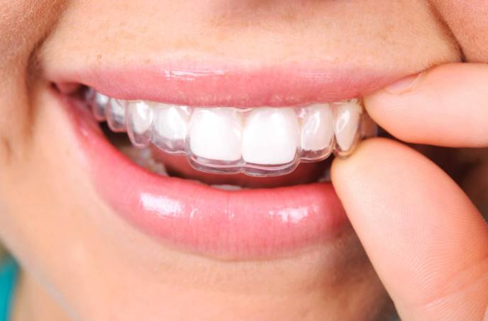 Invisalign Near Me Rosedale thumbnail